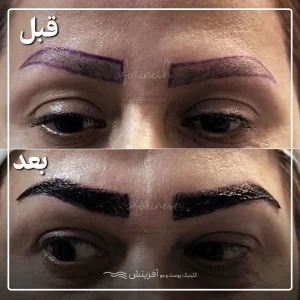 مثالی از عکس قبل و بعد کاشت ابرو