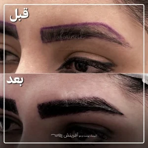 بهترین قبل و بعد کاشت ابرو