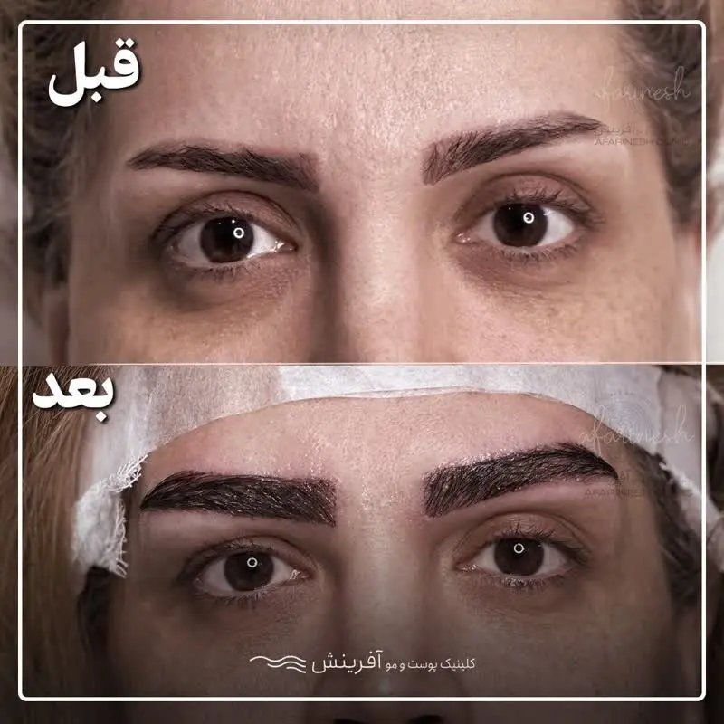 مدلی از قبل و بعد کاشت ابرو