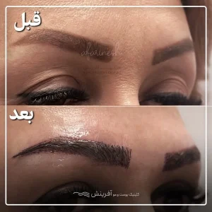 عکس کاشت ابرو بعد از یک ماه
