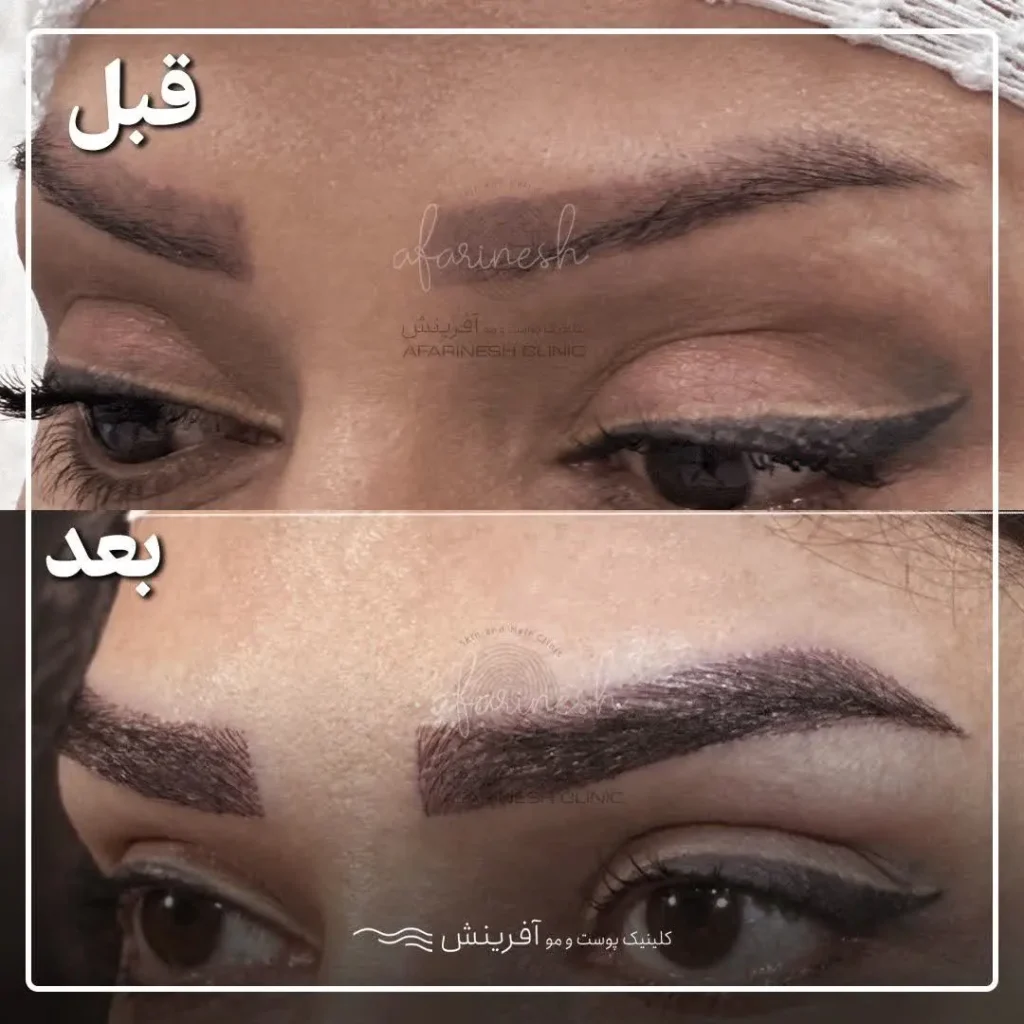 تصاویر کاشت ابرو