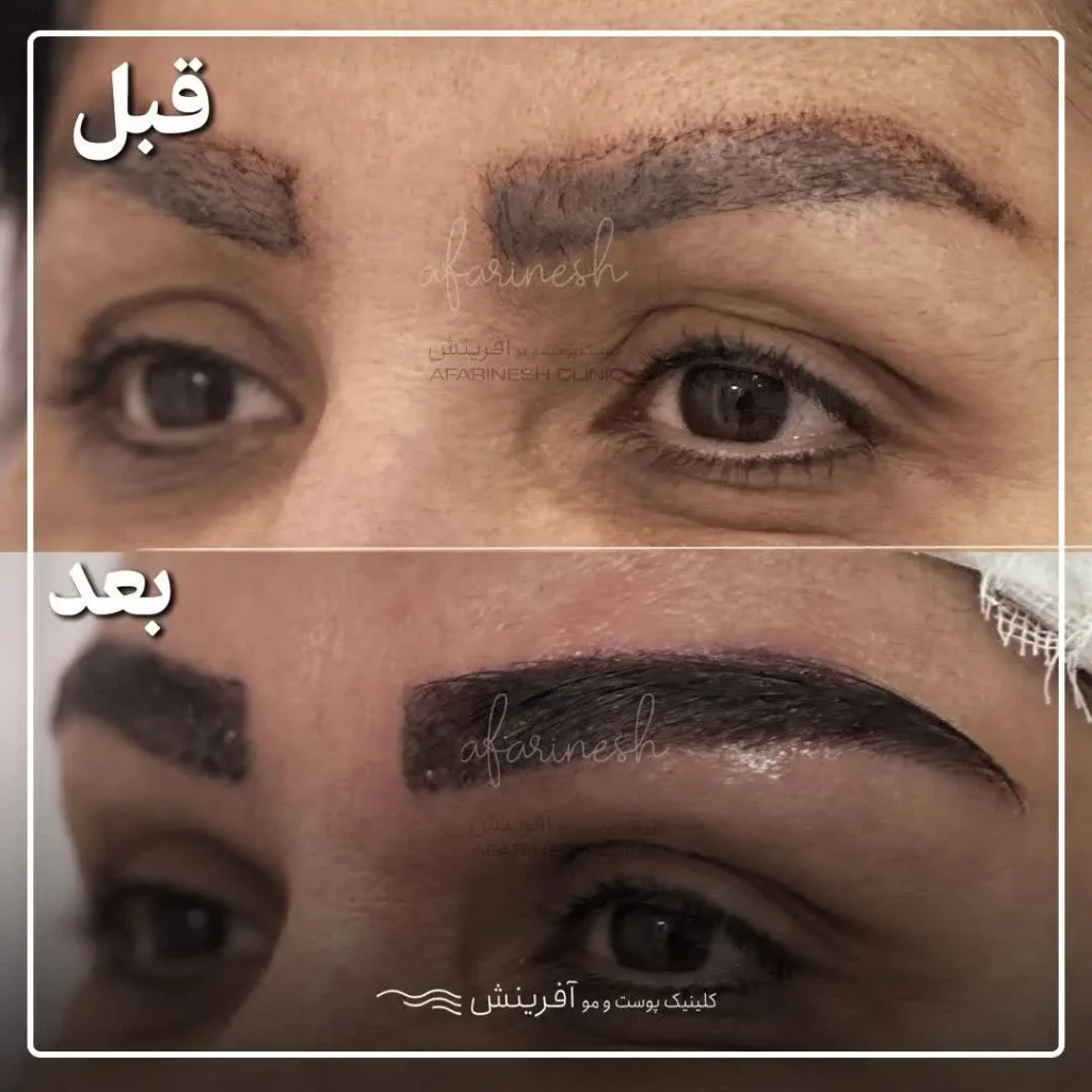 تصاویر کاشت ابرو