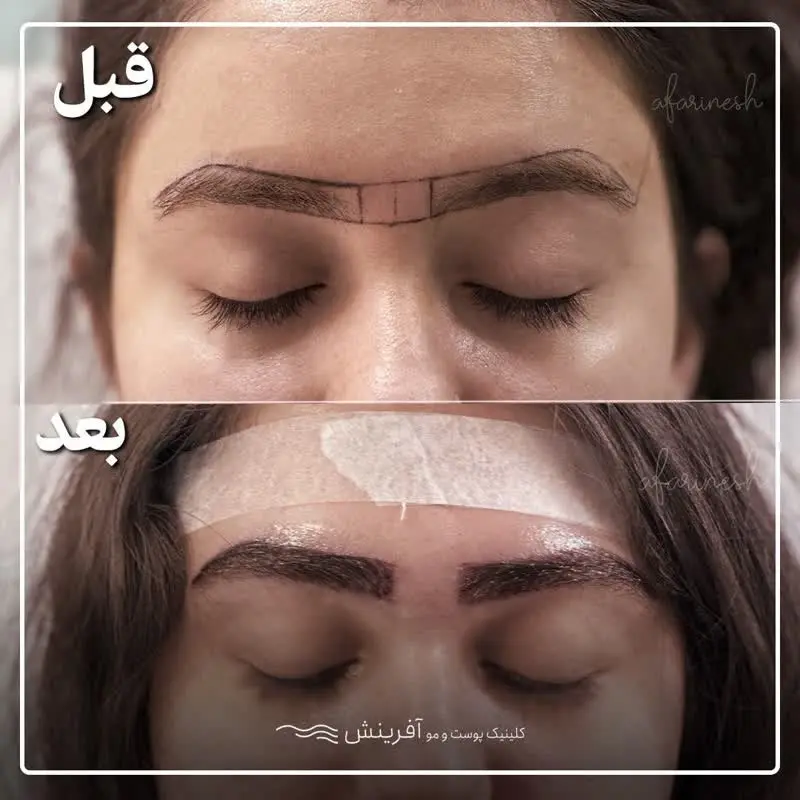 مدل بعد و قبل کاشت ابرو