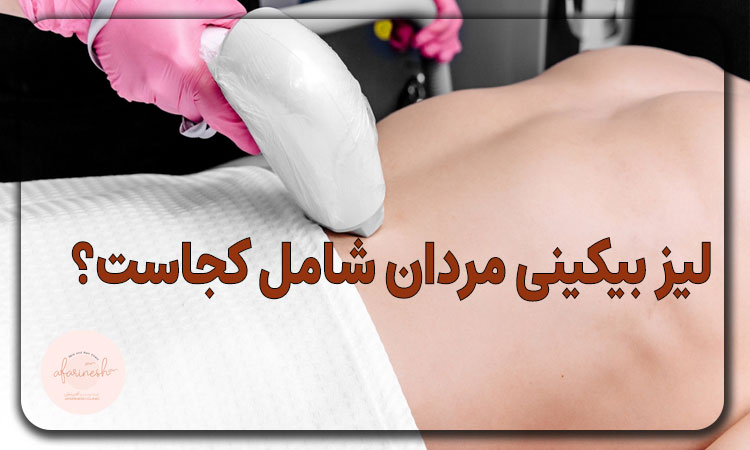 لیزر بیکینی مردان شامل کجاست