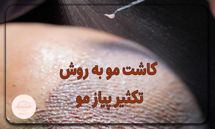کاشت مو به روش تکثیر پیاز مو