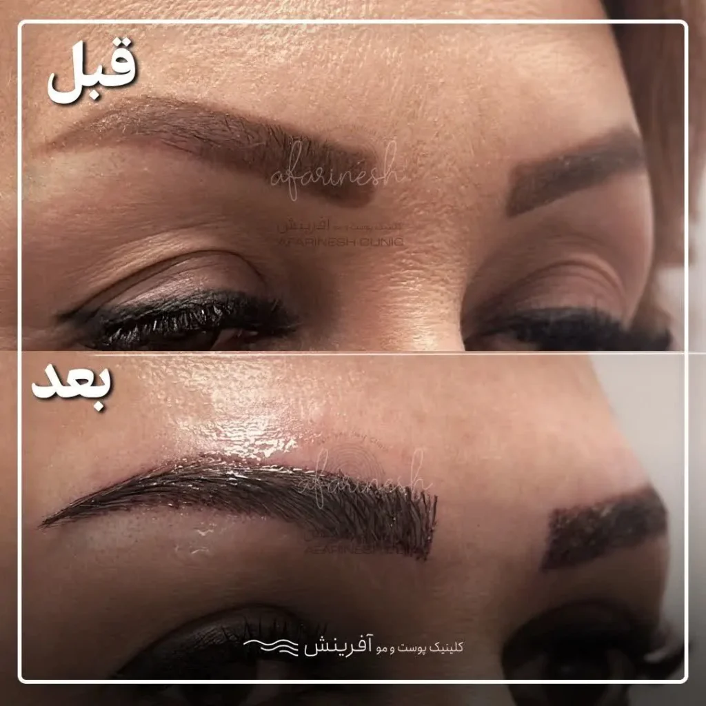 عکس کاشت ابرو بعد از یک ماه