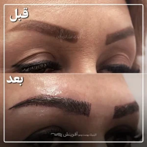 عکس کاشت ابرو بعد از یک ماه