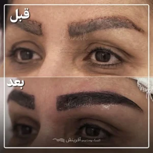 تصاویر کاشت ابرو