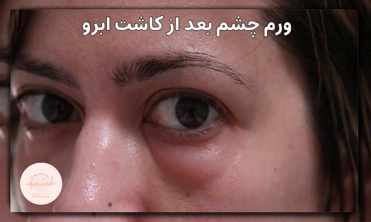درمان ورم چشم بعد از کاشت ابرو
