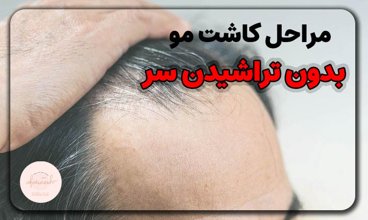 کاشت مو بدون تراشیدن سر
