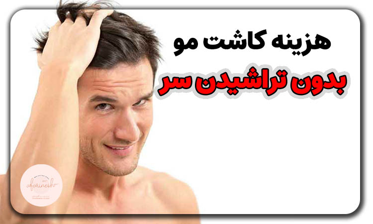 کاشت مو بدون تراشیدن سر