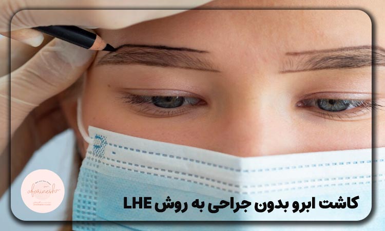 کاشت ابرو بدون جراحی به روش LHE