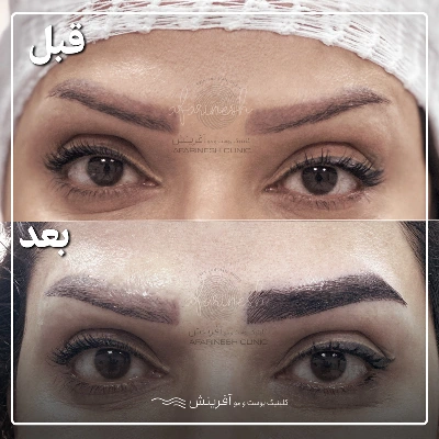 نمونه کاشت ابرو قبل و بعد