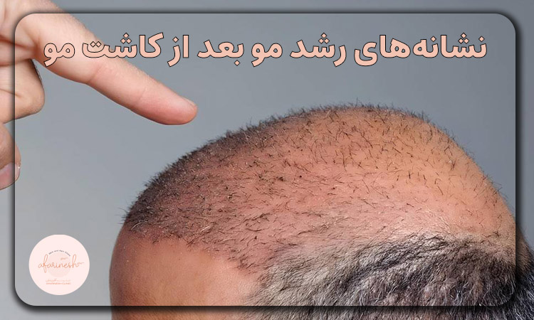 نشانه های رشد مو بعد از کاشت مو