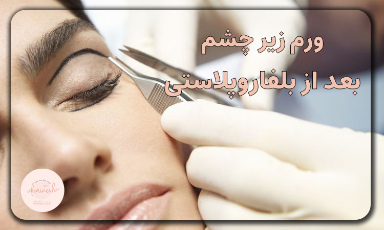 ورم بعد از عمل بلفاروپلاستی