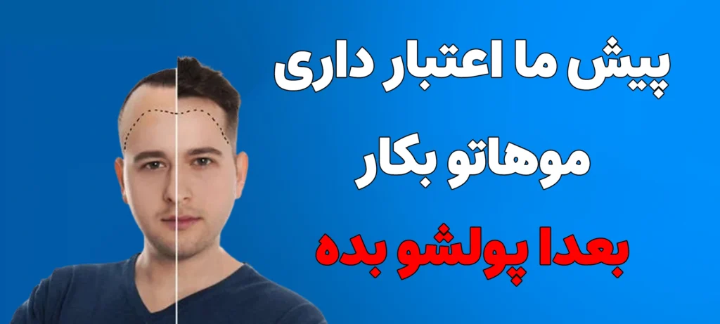 کاشت مو اقساطی