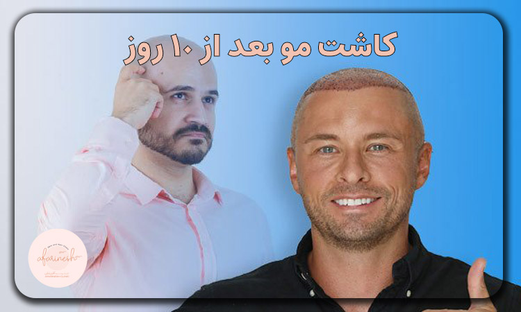 کاشت مو بعد از 10 روز