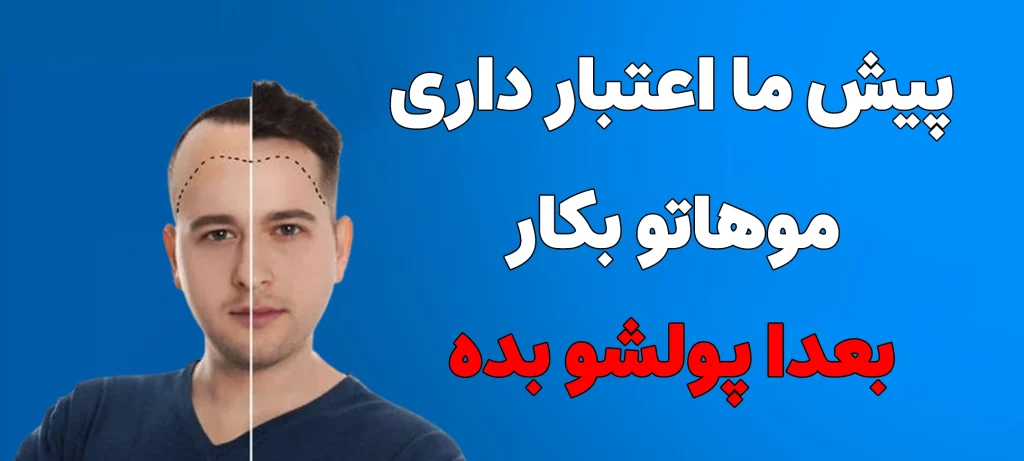 کاشت مو اقساطی