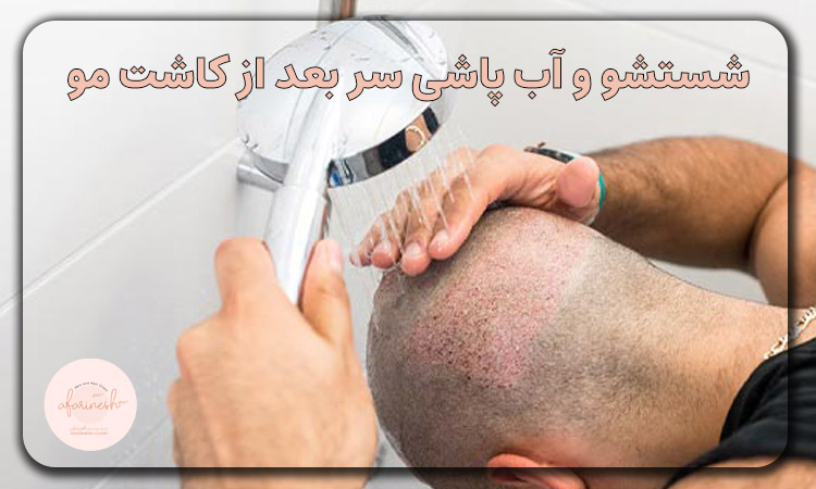 شستشو و آب پاشی سر بعد از کاشت مو