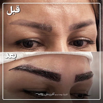 قبل و بعد از کاشت ابرو