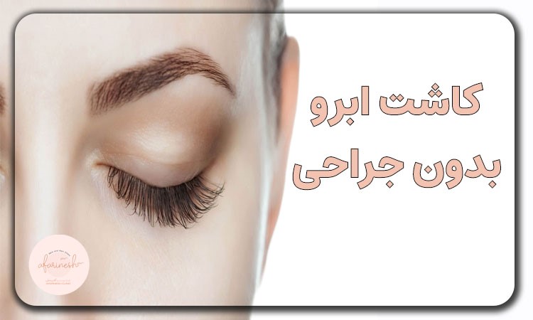 قیمت کاشت ابرو بدون جراحی