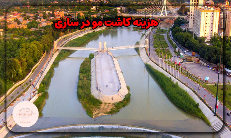 هزینه کاشت مو در ساری