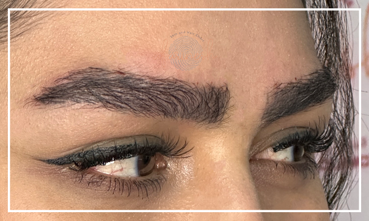 تصویر ریزش ابرو بعد از کاشت