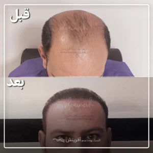 قبل بعد عمل کاشت مو