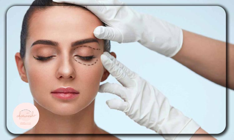 چه زمانی بعد از عمل بلفاروپلاستی نیاز به عمل مجدد پیدا می‌کنیم؟