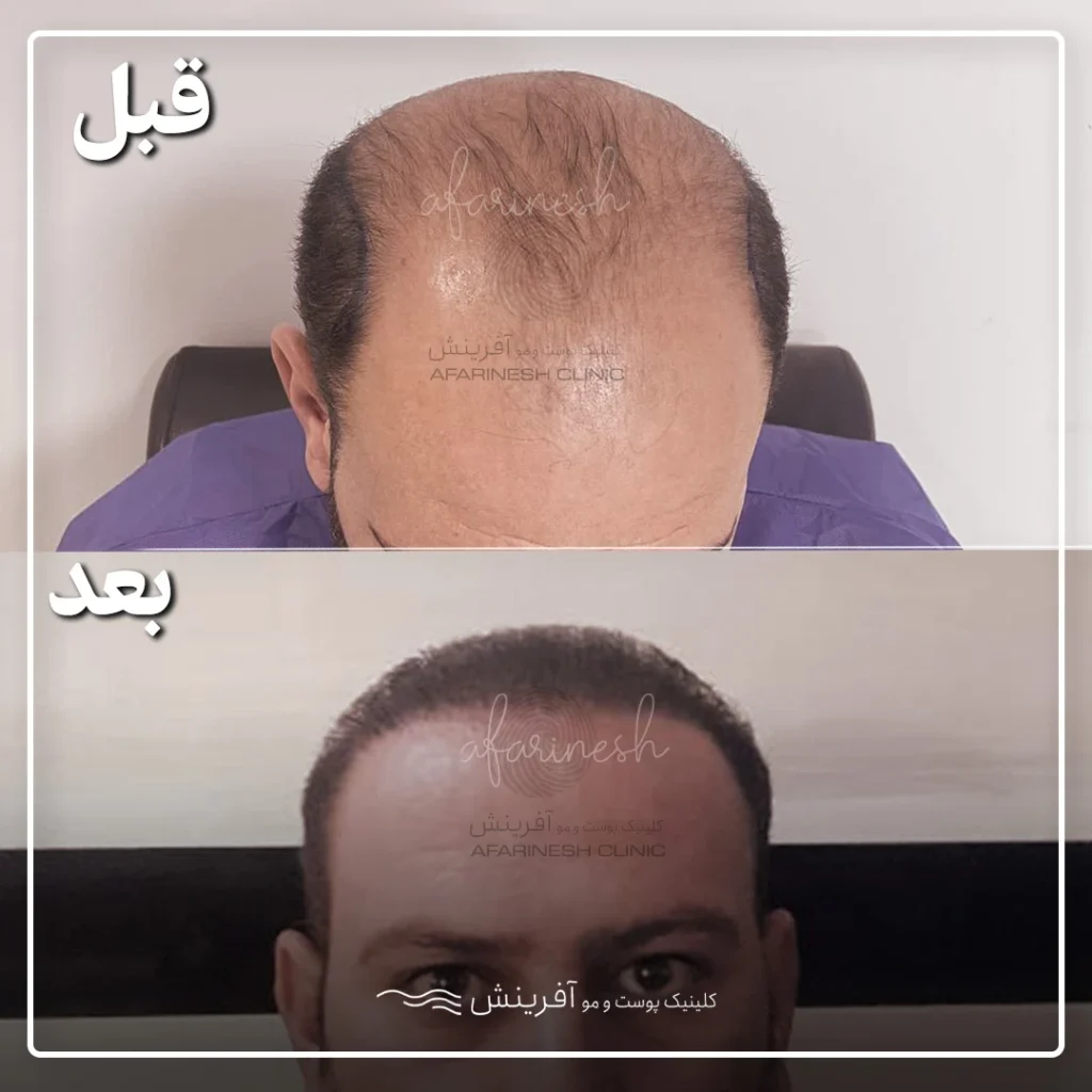 قبل بعد عمل کاشت مو
