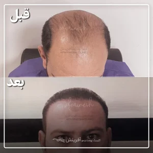 قبل بعد عمل کاشت مو