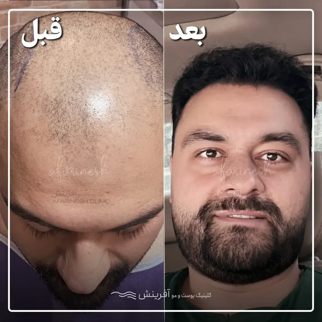 قبل بعد کاشت مو