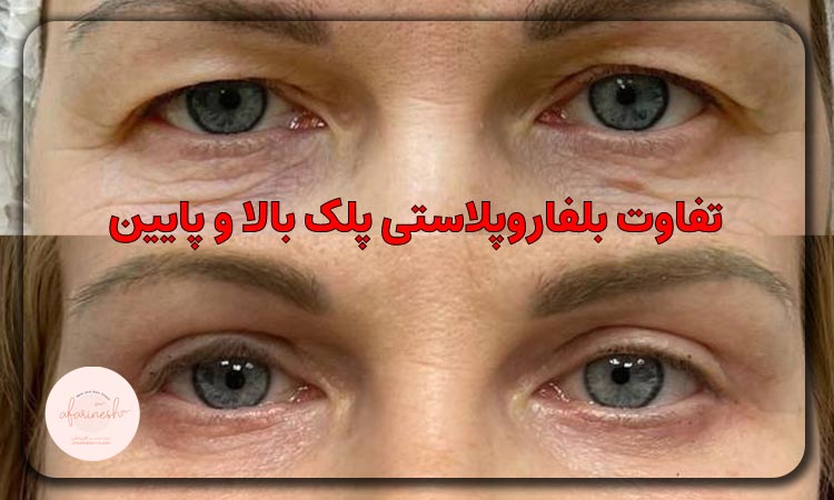 تفاوت بلفاروپلاستی پلک بالا و پایین