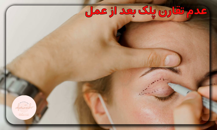 عدم تقارن پلک بعد از عمل