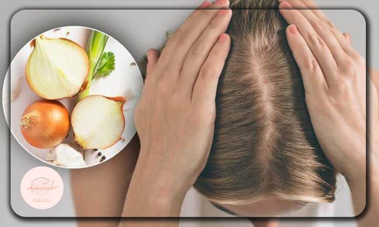 درمان خانگی ریزش مو با پیاز