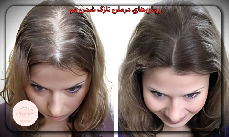 روشهای درمان نازک شدن مو