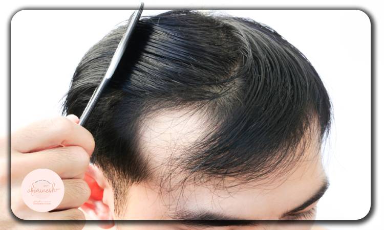 علت ریزش مو در سن 17 سالگی پسران