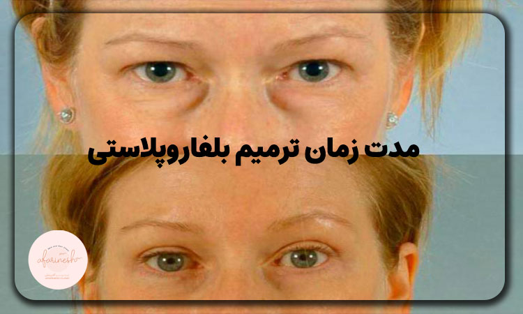 مدت زمان ترمیم بلفاروپلاستی
