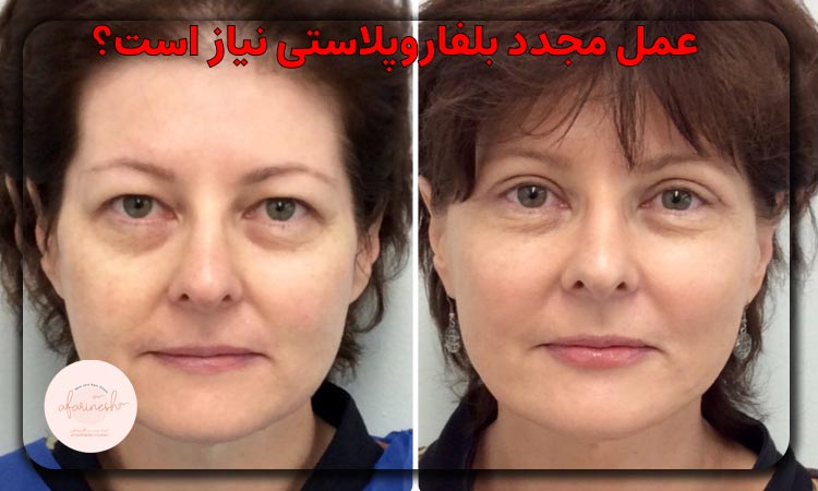 عمل مجدد بلفاروپلاستی نیاز است؟