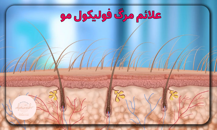 علائم مرگ فولیکول مو
