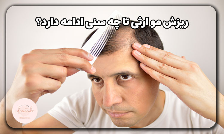 سن ریزش موی ارثی