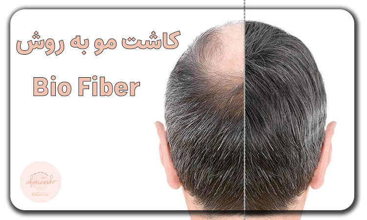 کاشت مو به روش بایوفایبر