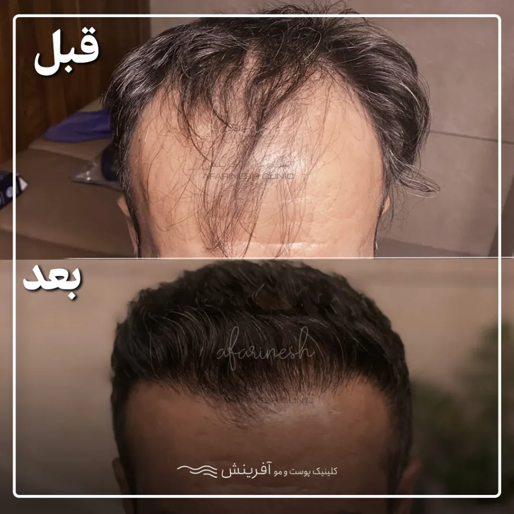 قبل بعد کاشتن مو