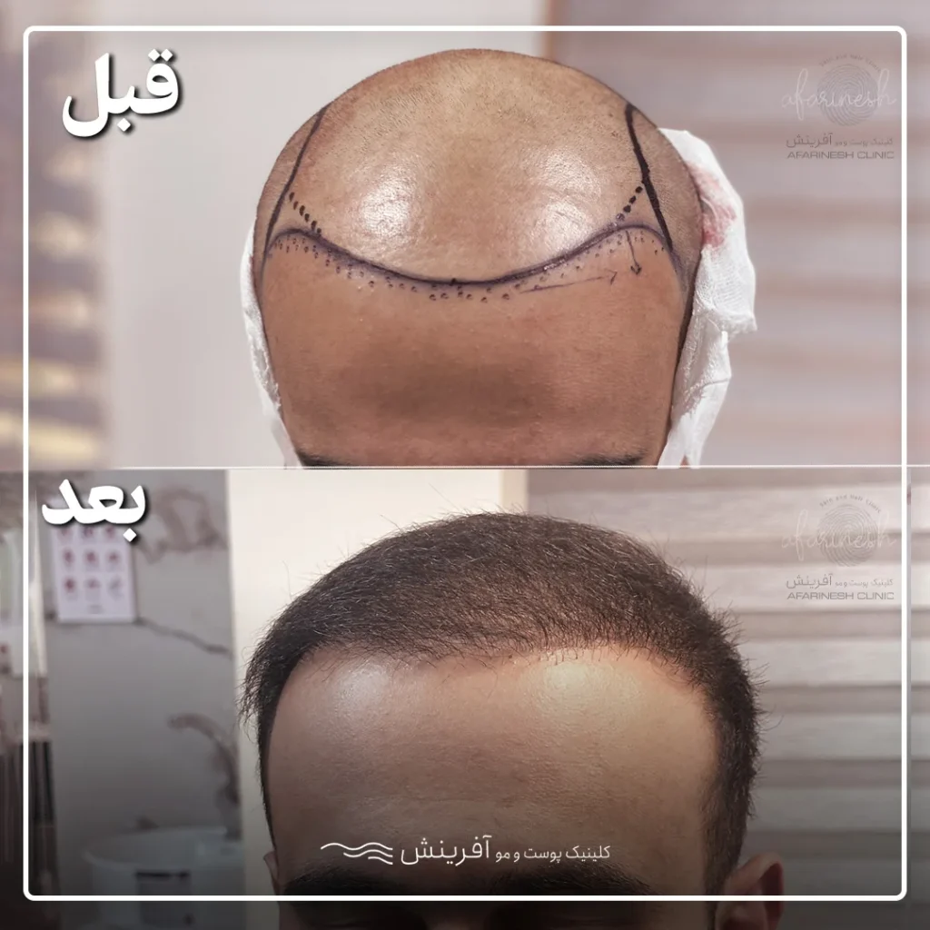 قبل و بعد از عمل کاشتن مو