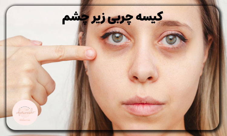 چگونه چربی زیر چشم را از بین ببریم؟