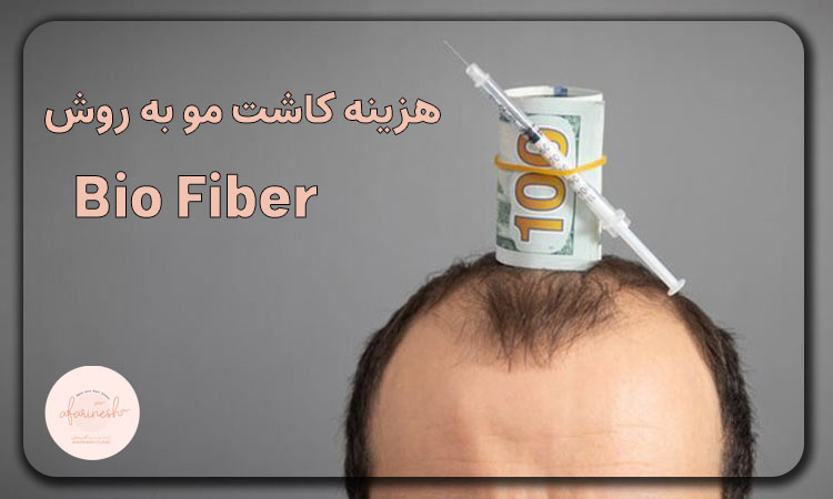 هزینه کاشت مو بایوفایبر
