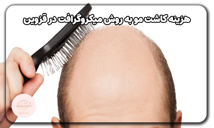 هزینه کاشت مو به روش میکروگرافت در قزوین