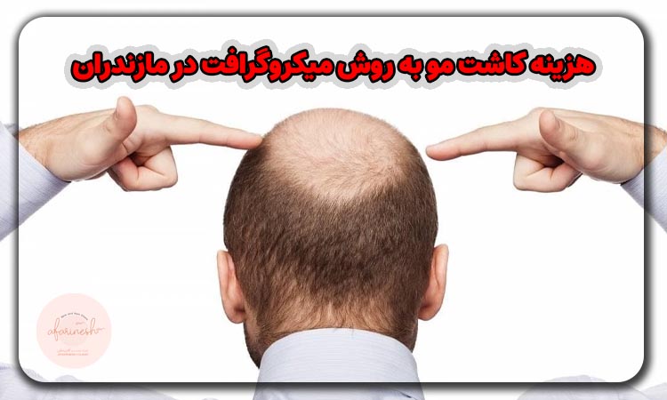 هزینه کاشت مو به روش میکروگرافت