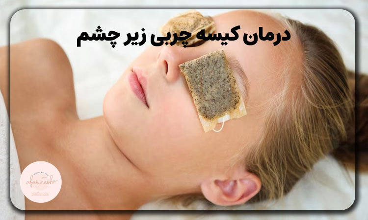 درمان خانگی چربی زیر چشم