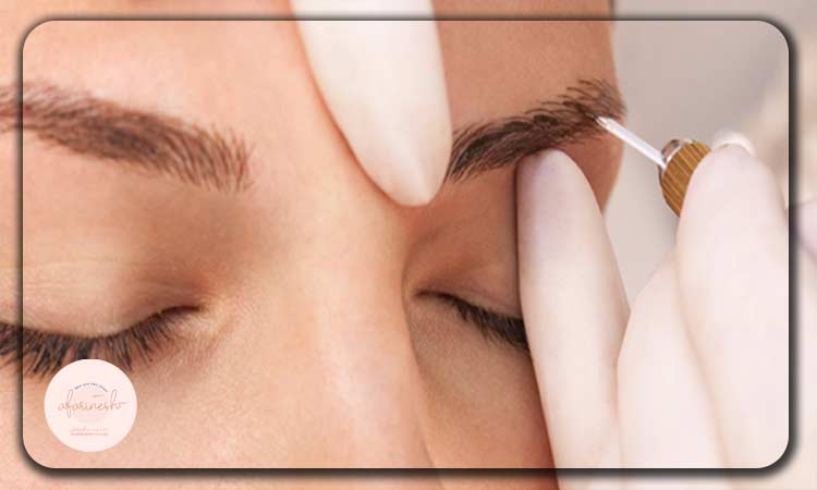 کاشت ابرو، یکی از روش‌های درمان ریزش ابرو